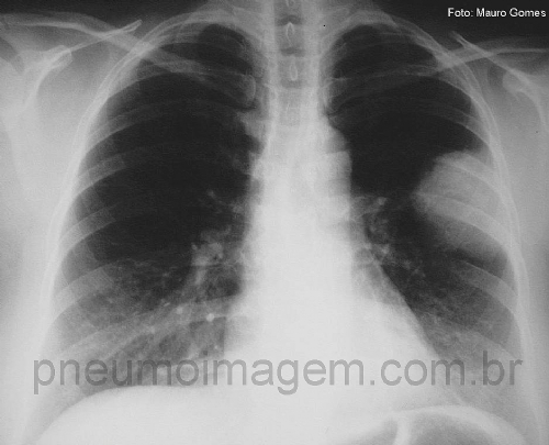 DEVE-SE UTILIZAR AS DUAS VACINAS PNEUMOC�CICAS EM IMUNOSSUPRIMIDOS